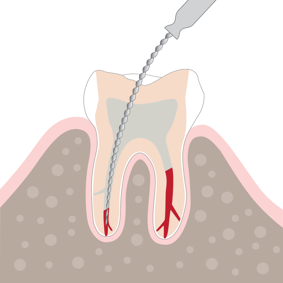 Nach Eröffnung des Zahninneren: Exstirpation entzündeter bzw. abgestorbener Pulpa mit rotierendem Instrument